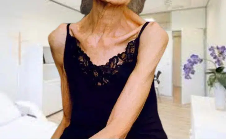 sindrome constitucional, caquexia